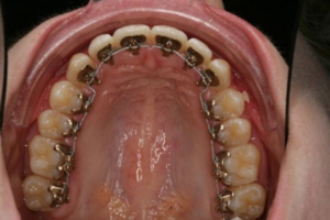 Linguale beugel Orthodontie Hoofddorp